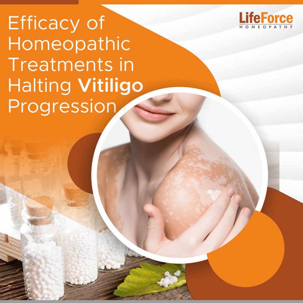 Efficacy of Homeopathic Treatments in Halting Vitiligo Progression