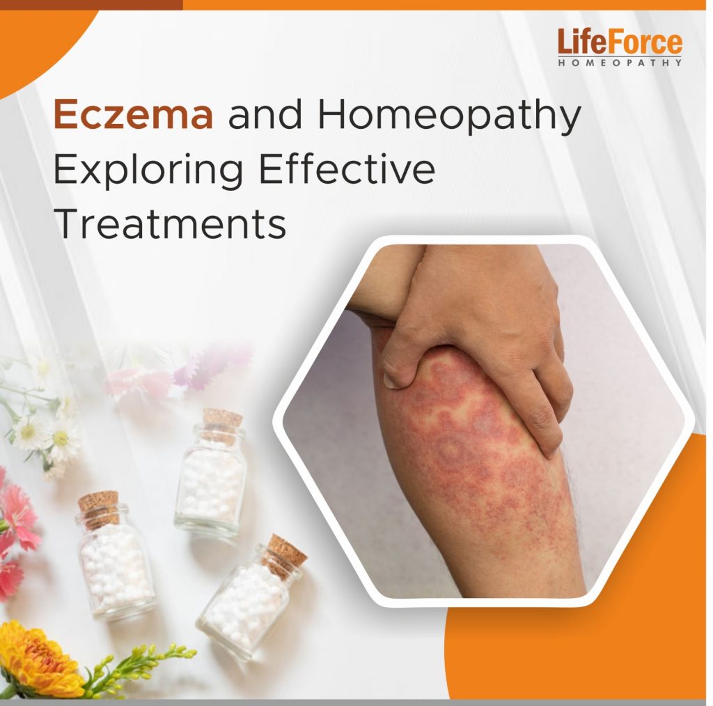 Eczema and Homeopathy: Exploring Effective Treatments