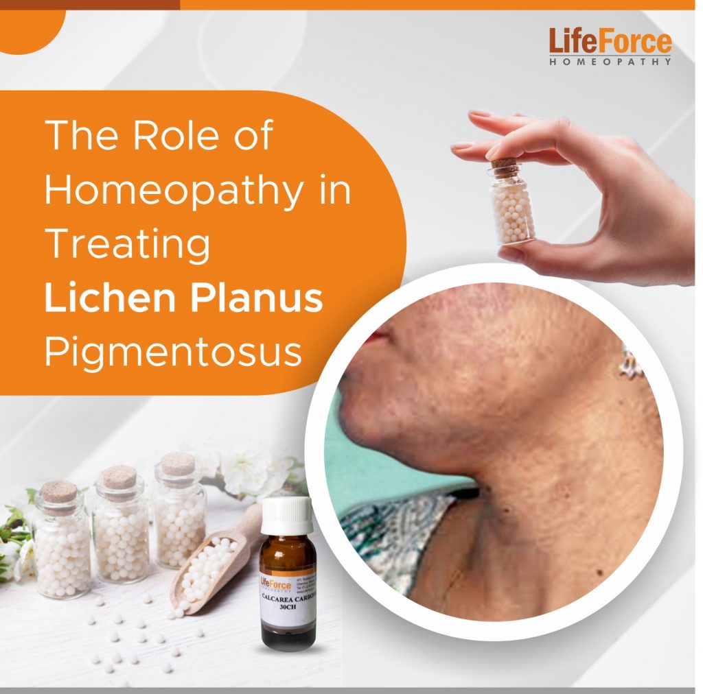 The Role of Homeopathy in Treating Lichen Planus Pigmentosus