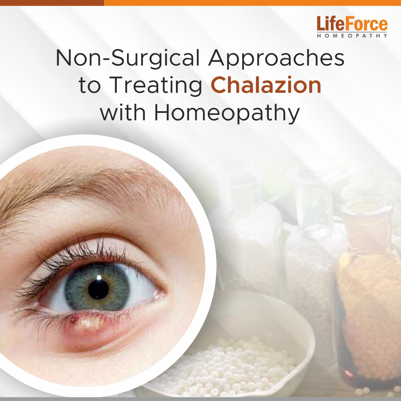 The Homeopathic way, non-Surgical treatment for Chalazion