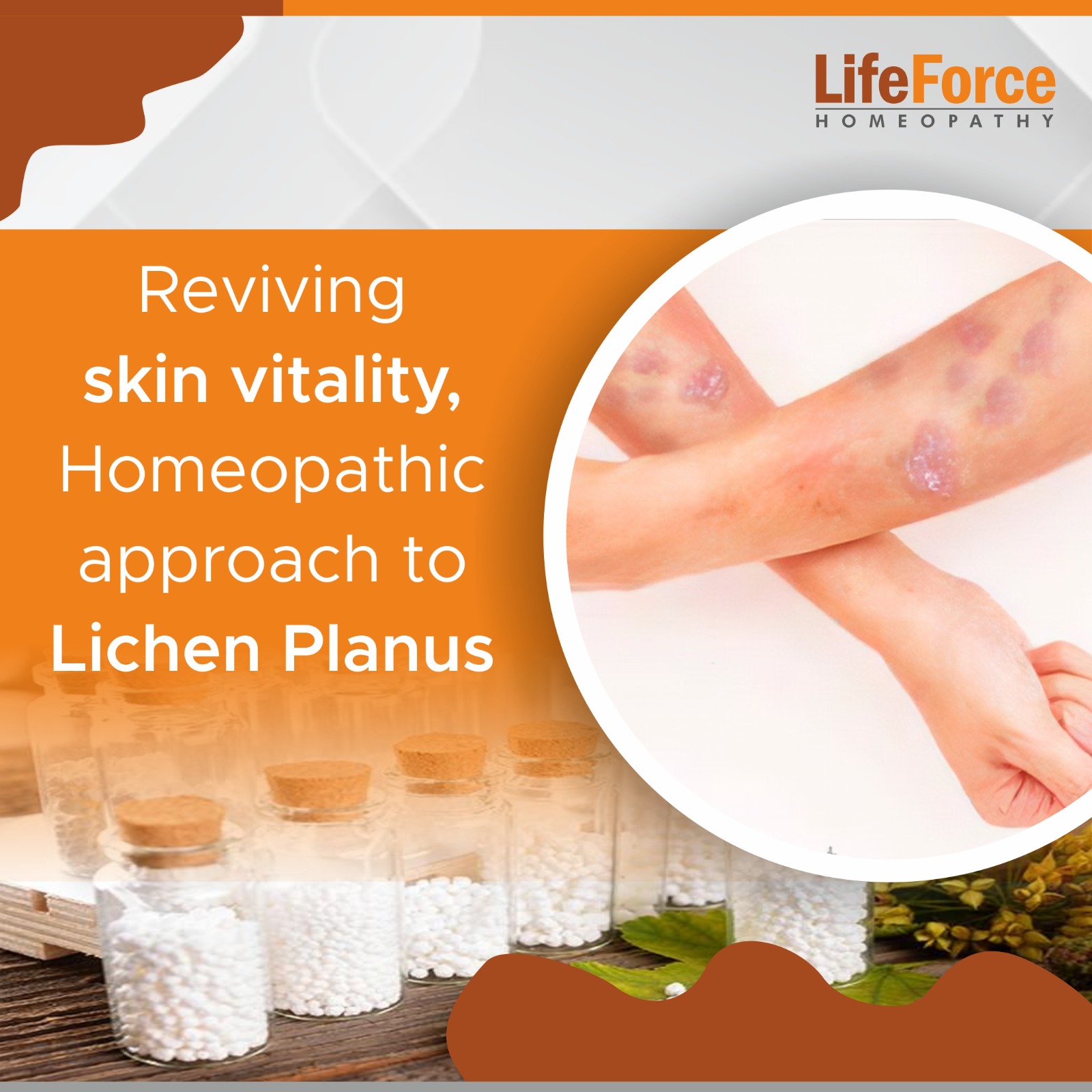 Reviving skin vitality, Homeopathic approach to Lichen Planus