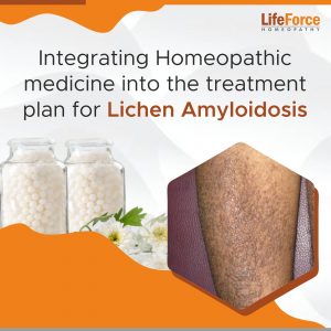 Integrating Homeopathic medicine into the treatment plan for Lichen Amyloidosis