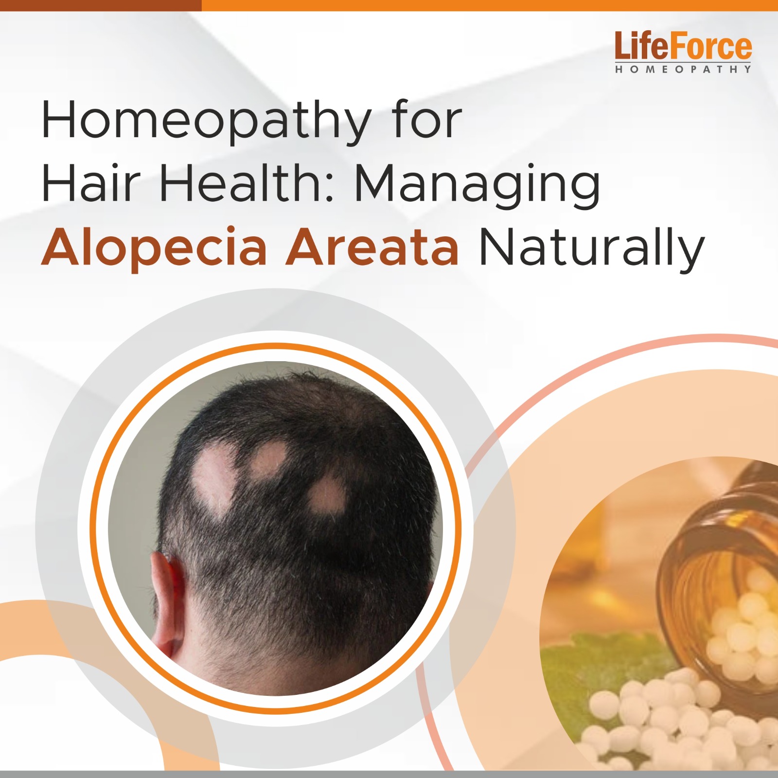 Homeopathy for Hair Health: Managing Alopecia Areata Naturally