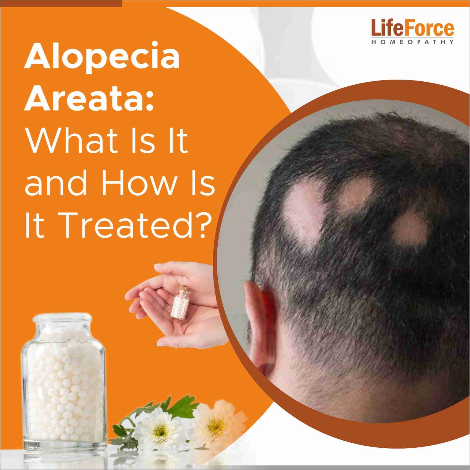 Alopecia Areata: What Is It and How Is It Treated?