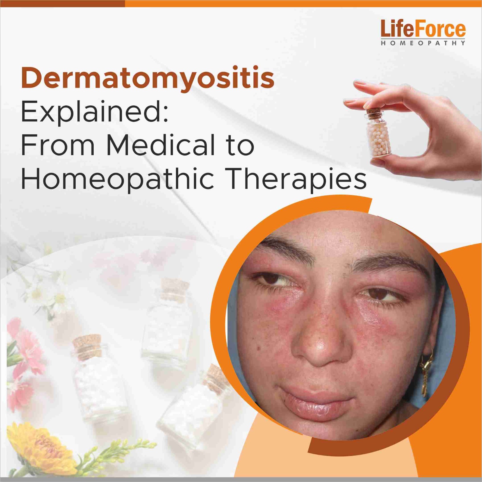 Dermatomyositis Explained: From Medical to Homeopathic Therapies