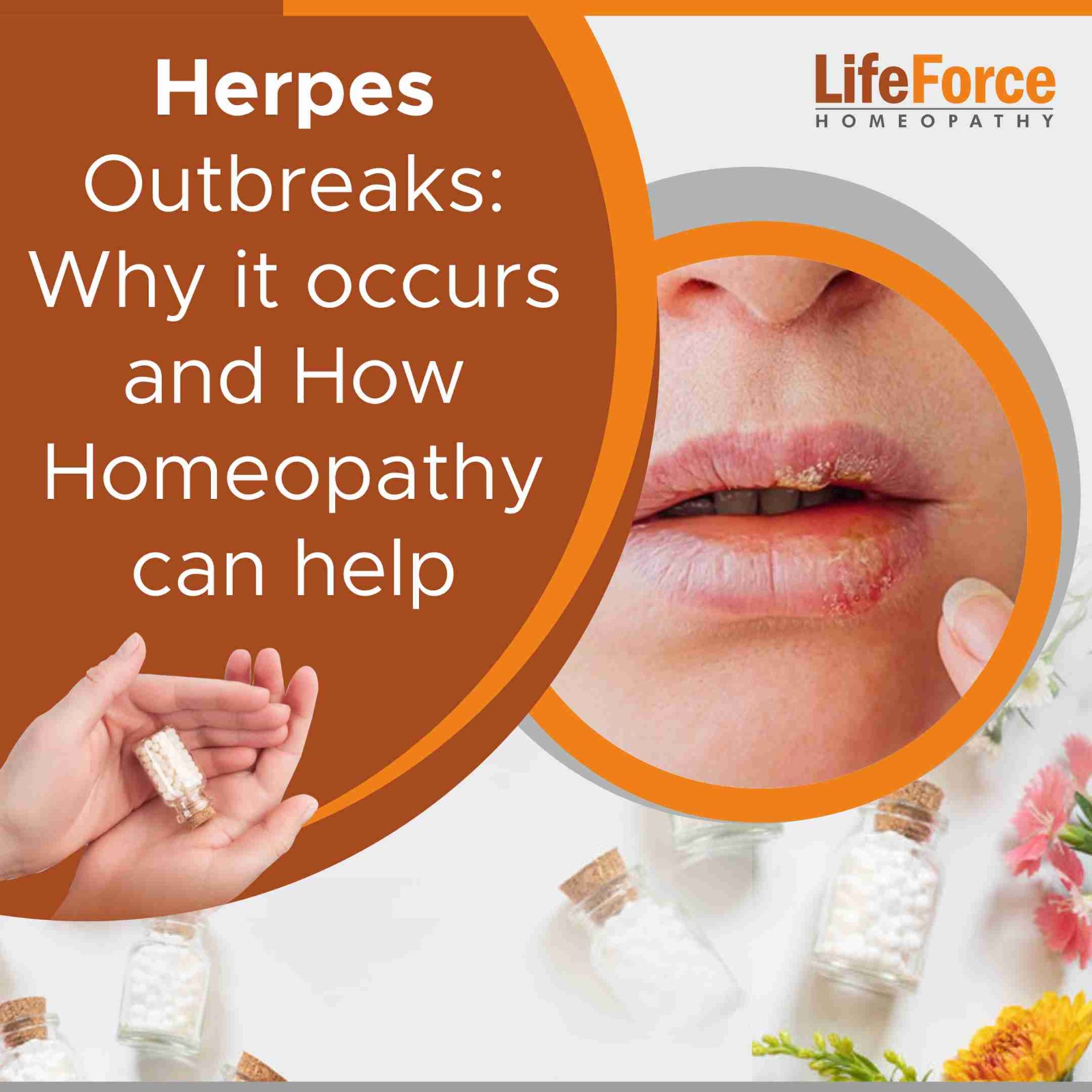 Herpes Outbreaks: Why it occurs and How Homeopathy can help