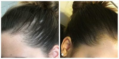 alopecia capelli agli ormonali sbalzi caduta legata affrontare lifeforce