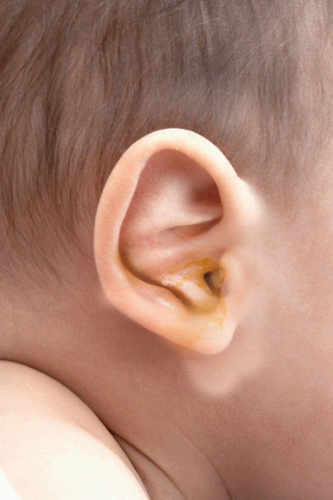 ear-infection-in-babies-10-ear-infection-symptoms-in-babies