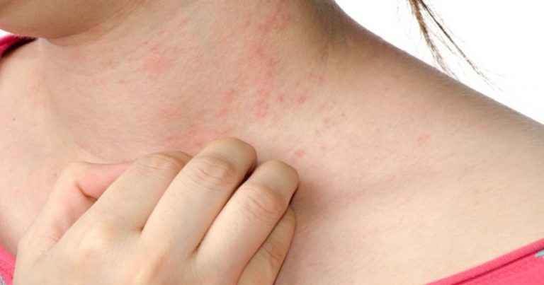 4-eczema-triggers-you-must-avoid