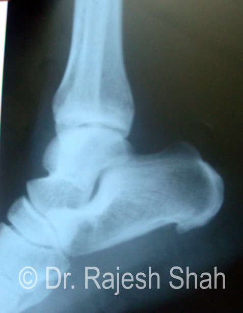 homeopathic medicine for calcaneal spur