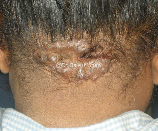 Homeopathic Treatment For Keloid I Causes Symptoms And Diagnosis