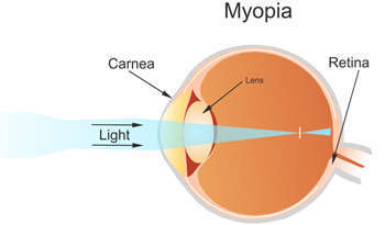 Symptoms of Myopia
