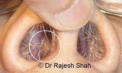 nasal polyps in toddlers