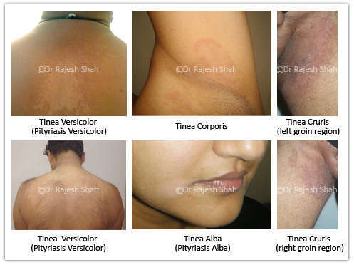 Tinea Versicolor Treatment in California through Ayurveda