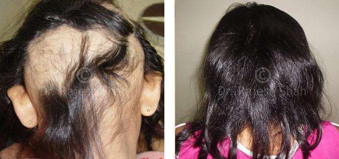 Natural Hair Loss Treatment Why Does Hair Fall After Applying Oil