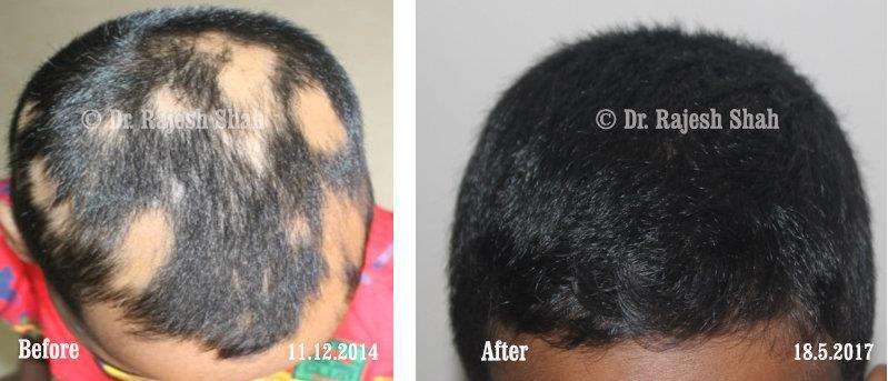 alopecia universalis homeopathic treatment